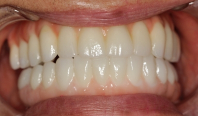 Close up of complete smile after getting implant dentures